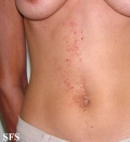 darier's disease-linear darier's disease