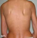 darier's disease-linear darier's disease