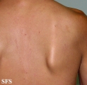 darier's disease-linear darier's disease