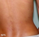 darier's disease-linear darier's disease