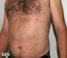 darier's disease-linear darier's disease