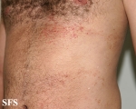 darier's disease-linear darier's disease