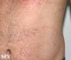 darier's disease-linear darier's disease