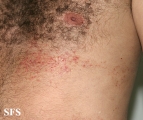 darier's disease-linear darier's disease