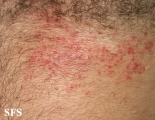darier's disease-linear darier's disease
