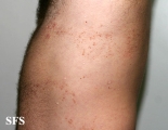 darier's disease-linear darier's disease