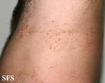 darier's disease-linear darier's disease