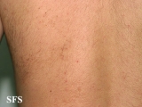 darier's disease-linear darier's disease