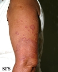 granuloma multiforme