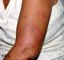 granuloma multiforme