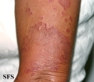 granuloma multiforme