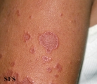 granuloma multiforme