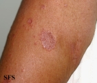 granuloma multiforme