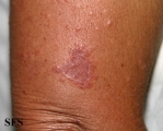 granuloma multiforme