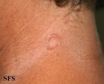granuloma multiforme