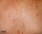 granuloma multiforme