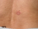 granuloma multiforme