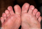 tinea pedis