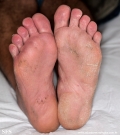 tinea pedis