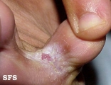 tinea pedis