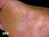 tinea pedis