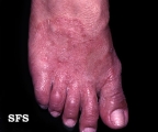 tinea pedis