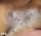 tinea pedis