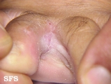 tinea pedis