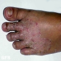 tinea pedis