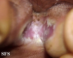 tinea pedis