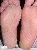 tinea pedis