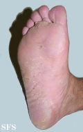 tinea pedis