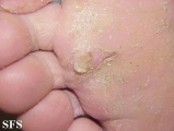 tinea pedis