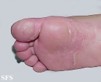 tinea pedis