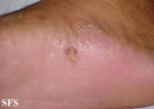 tinea pedis