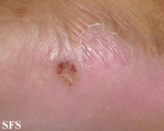 tinea pedis