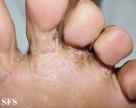 tinea pedis