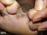 tinea pedis