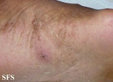 tinea pedis