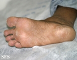 tinea pedis