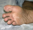 tinea pedis