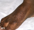 tinea pedis