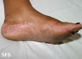 tinea pedis