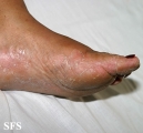 tinea pedis