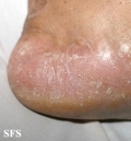 tinea pedis