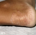 tinea pedis