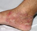tinea pedis