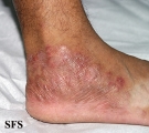 tinea pedis