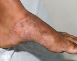 tinea pedis