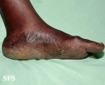 tinea pedis